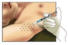 hyperhidrosis Generaal